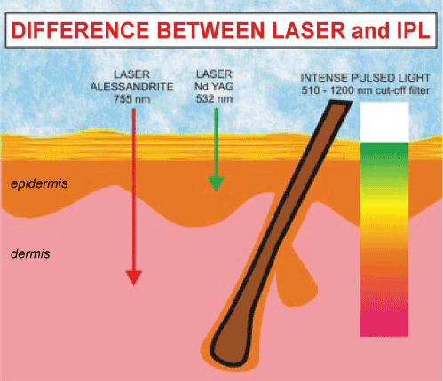Difference between Laser and IPL