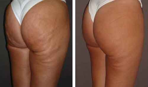 Karboxyterapia